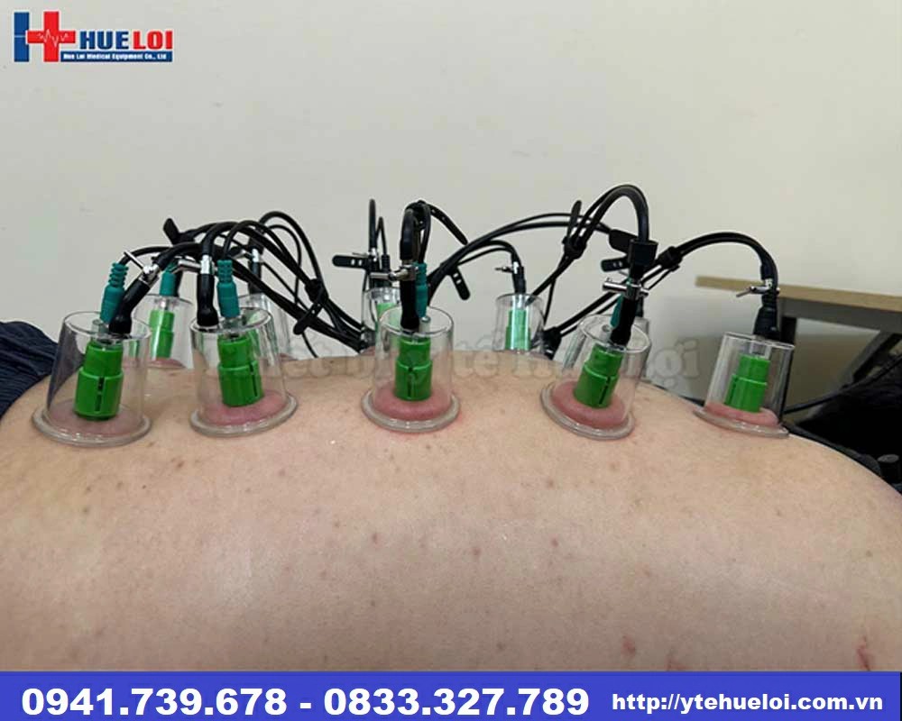 Máy điện châm không kim kết hợp giác hút