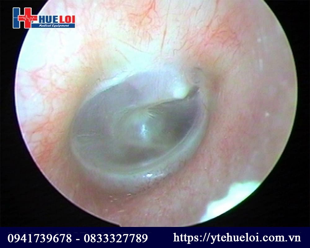 hình ảnh nội soi màng nhĩ