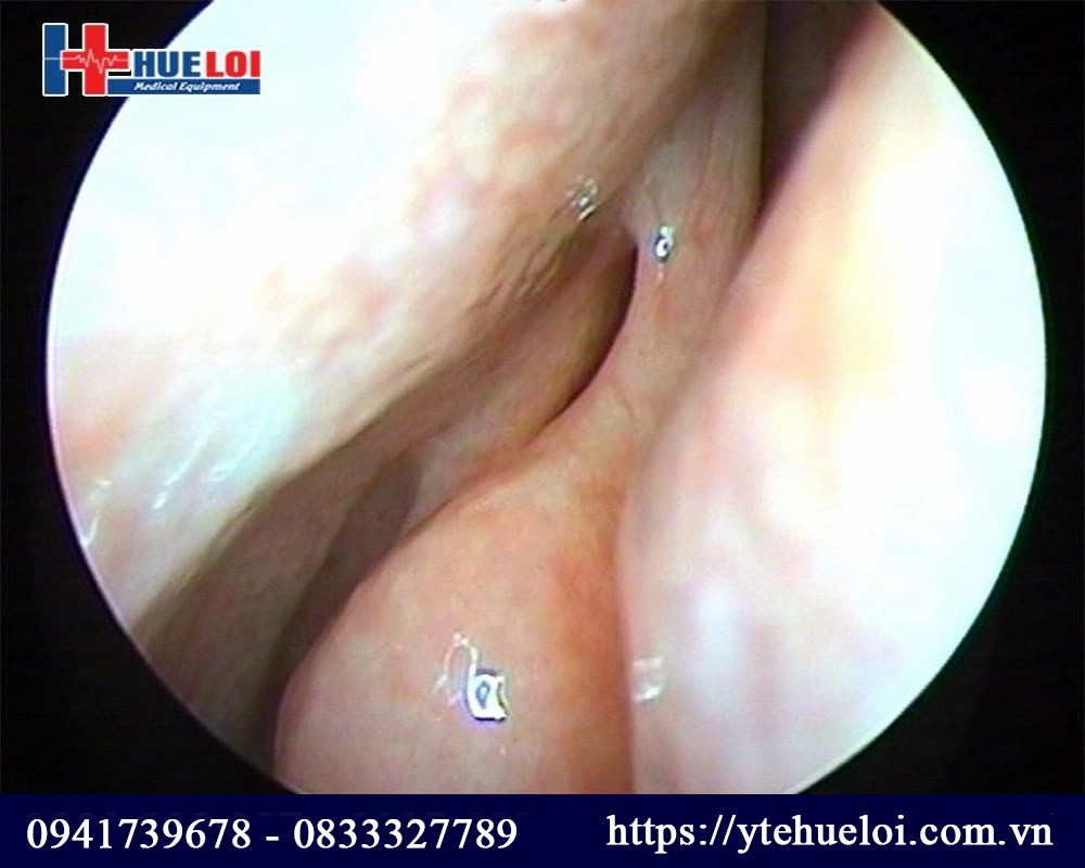 hình ảnh lâm sàng nội soi tai mũi họng