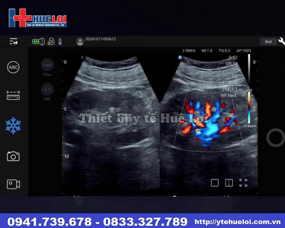 Máy siêu âm cầm tay di động