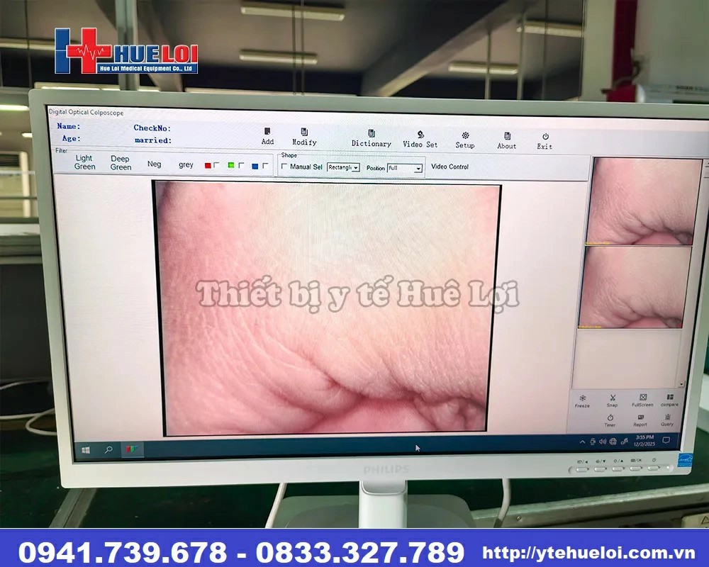 máy soi cổ tử cung sd