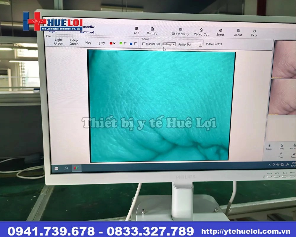 máy soi cổ tử cung