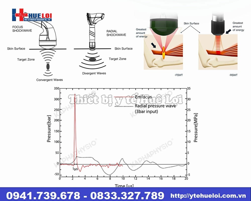Máy trị liệu bằng sóng xung kích hội tụ