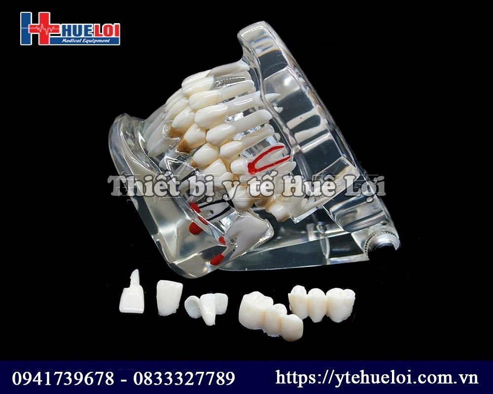 mô hình răng implan