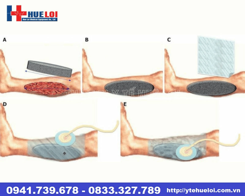 Máy hút áp lực âm NP-100 điều trị vết thương