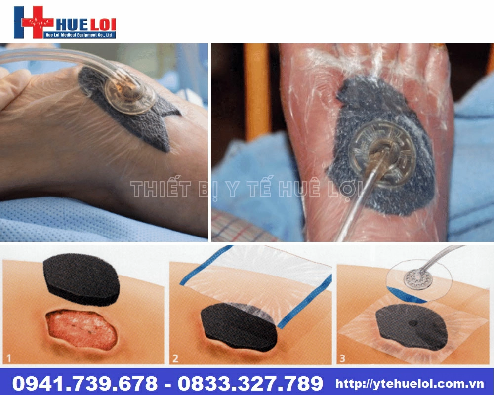 Máy hút áp lực âm NP-100 điều trị vết thương